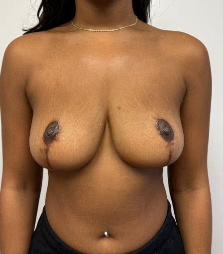 Plastic Surgery Specialists of New Jersey breast reduction after — Paramus, NJ