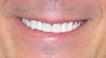 Inwood Village Dental smile makeover after — Dallas, TX
