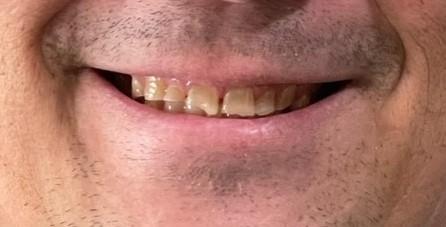 Smile Makeover before at Inwood Village Dental in Dallas, TX