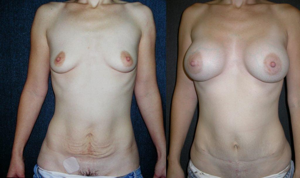 Andres Taleisnik, MD mommy makeover result — Orange, CA