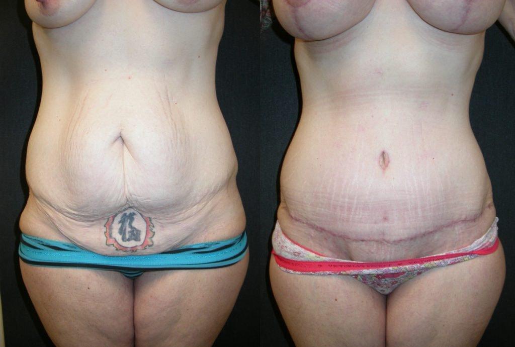 Andres Taleisnik, MD mommy makeover result — Orange, CA