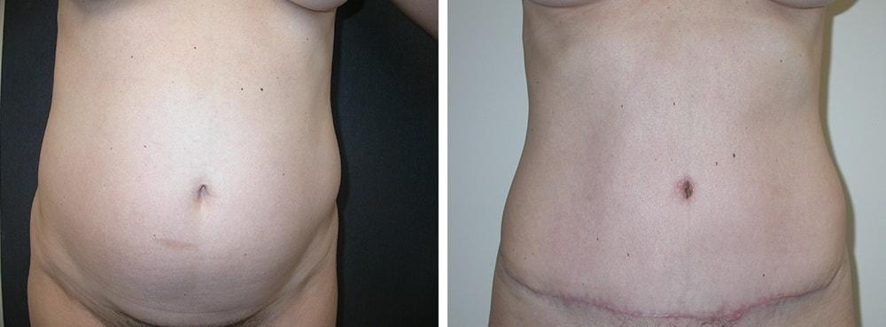 Andres Taleisnik, MD tummy tuck result — Orange, CA