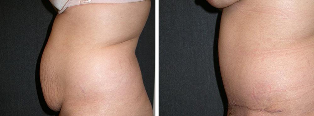 Andres Taleisnik, MD tummy tuck result — Orange, CA