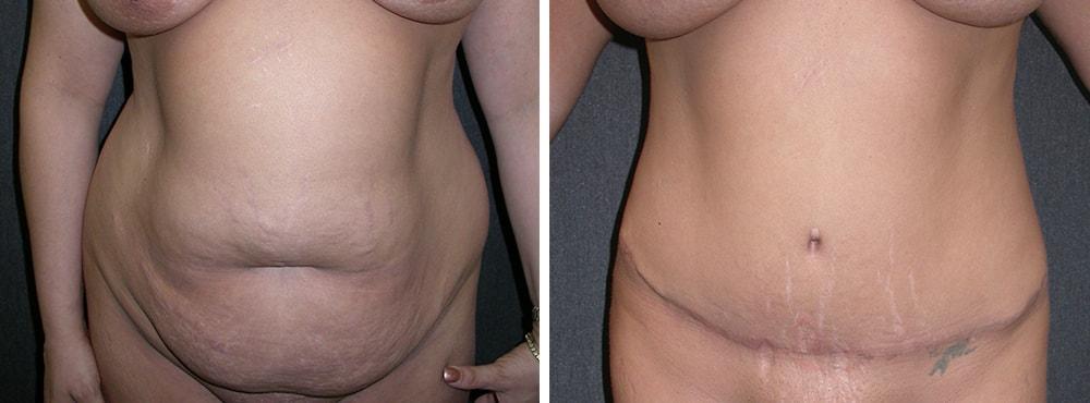 Andres Taleisnik, MD tummy tuck result — Orange, CA