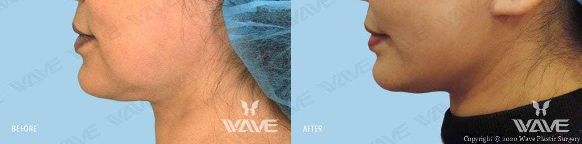 Wave Plastic Surgery & Aesthetic Laser Center Costa Mesa neck lift result — Costa Mesa, CA