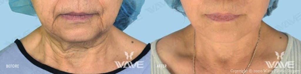 Wave Plastic Surgery & Aesthetic Laser Center Costa Mesa neck lift result — Costa Mesa, CA