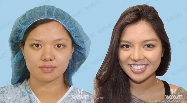 Functional Rhinoplasty result at Wave Plastic Surgery & Aesthetic Laser Center Costa Mesa in Costa Mesa, CA
