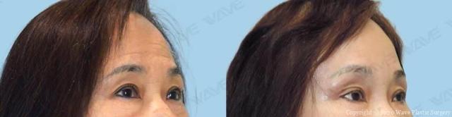 Blepharoplasty result at Wave Plastic Surgery & Aesthetic Laser Center Costa Mesa in Costa Mesa, CA