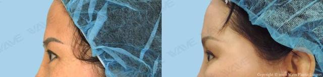 Blepharoplasty result at Wave Plastic Surgery & Aesthetic Laser Center Costa Mesa in Costa Mesa, CA