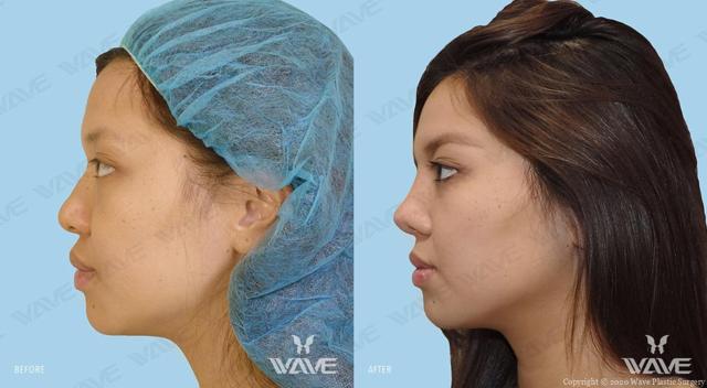 Functional Rhinoplasty result at Wave Plastic Surgery & Aesthetic Laser Center Costa Mesa in Costa Mesa, CA