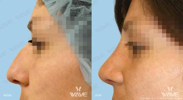 Rhinoplasty result at Wave Plastic Surgery & Aesthetic Laser Center Costa Mesa in Costa Mesa, CA