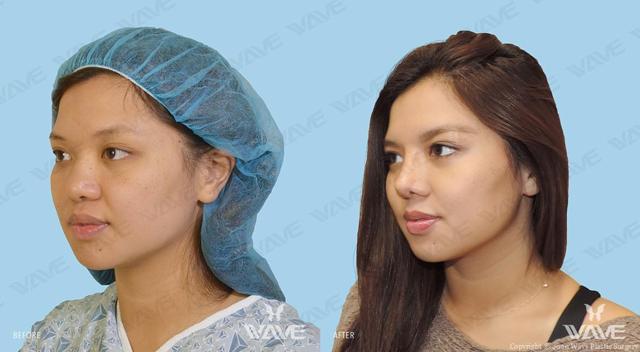 Functional Rhinoplasty result at Wave Plastic Surgery & Aesthetic Laser Center Costa Mesa in Costa Mesa, CA