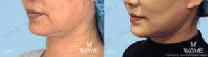 Wave Plastic Surgery & Aesthetic Laser Center Costa Mesa result — Costa Mesa, CA