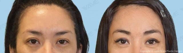 Blepharoplasty result at Wave Plastic Surgery & Aesthetic Laser Center Costa Mesa in Costa Mesa, CA