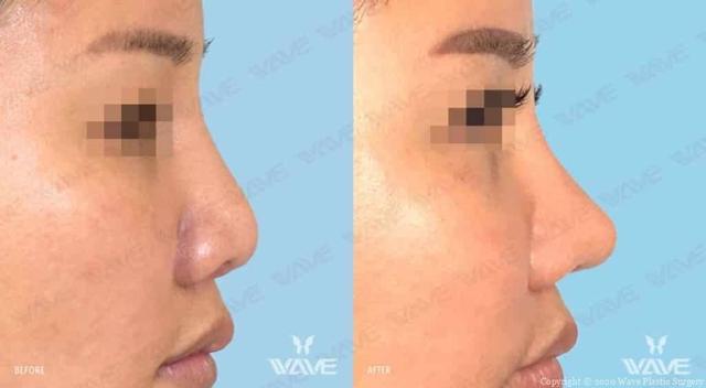 Rhinoplasty result at Wave Plastic Surgery & Aesthetic Laser Center Costa Mesa in Costa Mesa, CA
