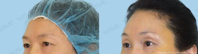 Blepharoplasty result at Wave Plastic Surgery & Aesthetic Laser Center Costa Mesa in Costa Mesa, CA