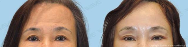 Blepharoplasty result at Wave Plastic Surgery & Aesthetic Laser Center Costa Mesa in Costa Mesa, CA