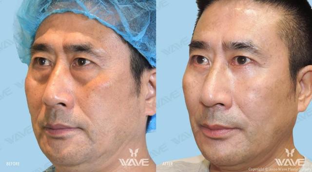 Blepharoplasty result at Wave Plastic Surgery & Aesthetic Laser Center Costa Mesa in Costa Mesa, CA