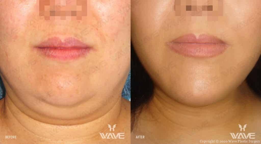 Wave Plastic Surgery & Aesthetic Laser Center Costa Mesa neck liposuction result — Costa Mesa, CA