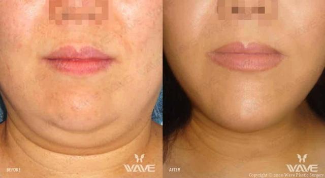 Neck Liposuction result at Wave Plastic Surgery & Aesthetic Laser Center Costa Mesa in Costa Mesa, CA