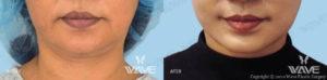 Wave Plastic Surgery & Aesthetic Laser Center Costa Mesa result — Costa Mesa, CA