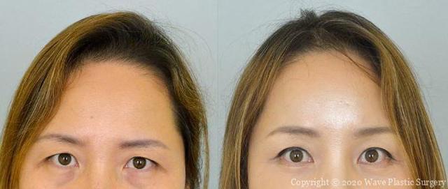 Blepharoplasty result at Wave Plastic Surgery & Aesthetic Laser Center Costa Mesa in Costa Mesa, CA