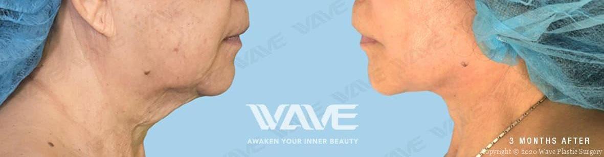 Wave Plastic Surgery & Aesthetic Laser Center Costa Mesa neck lift result — Costa Mesa, CA