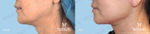Wave Plastic Surgery & Aesthetic Laser Center Costa Mesa result — Costa Mesa, CA