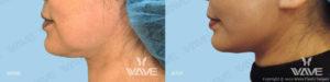 Wave Plastic Surgery & Aesthetic Laser Center Costa Mesa result — Costa Mesa, CA