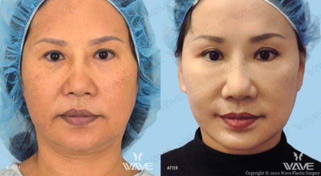 Blepharoplasty result at Wave Plastic Surgery & Aesthetic Laser Center Costa Mesa in Costa Mesa, CA