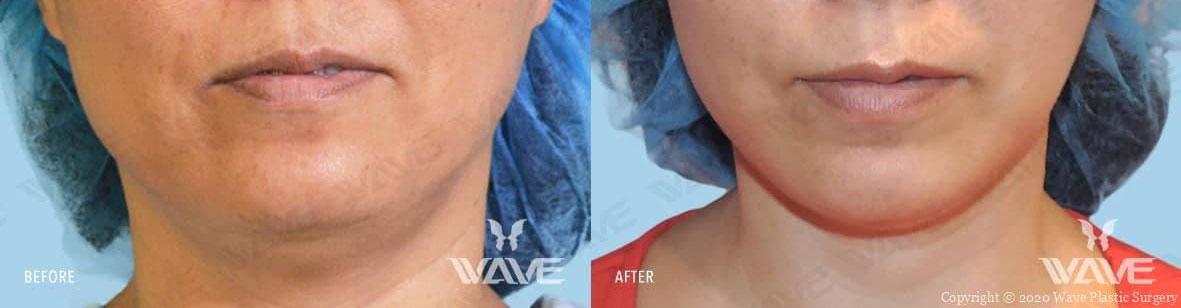 Wave Plastic Surgery & Aesthetic Laser Center Costa Mesa neck liposuction result — Costa Mesa, CA