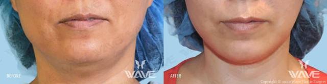 Neck Liposuction result at Wave Plastic Surgery & Aesthetic Laser Center Costa Mesa in Costa Mesa, CA