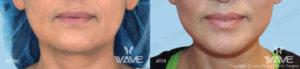 Wave Plastic Surgery & Aesthetic Laser Center Costa Mesa result — Costa Mesa, CA