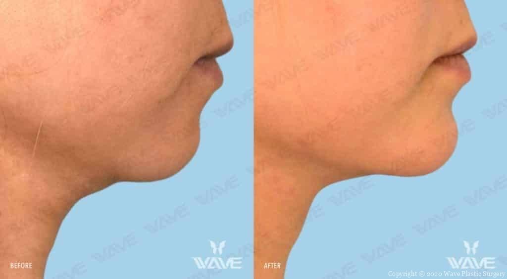 Wave Plastic Surgery & Aesthetic Laser Center Costa Mesa neck liposuction result — Costa Mesa, CA