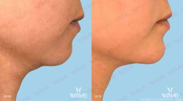 Neck Liposuction result at Wave Plastic Surgery & Aesthetic Laser Center Costa Mesa in Costa Mesa, CA