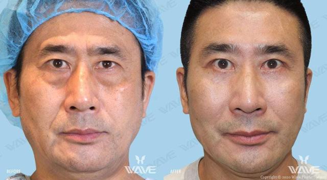 Blepharoplasty result at Wave Plastic Surgery & Aesthetic Laser Center Costa Mesa in Costa Mesa, CA