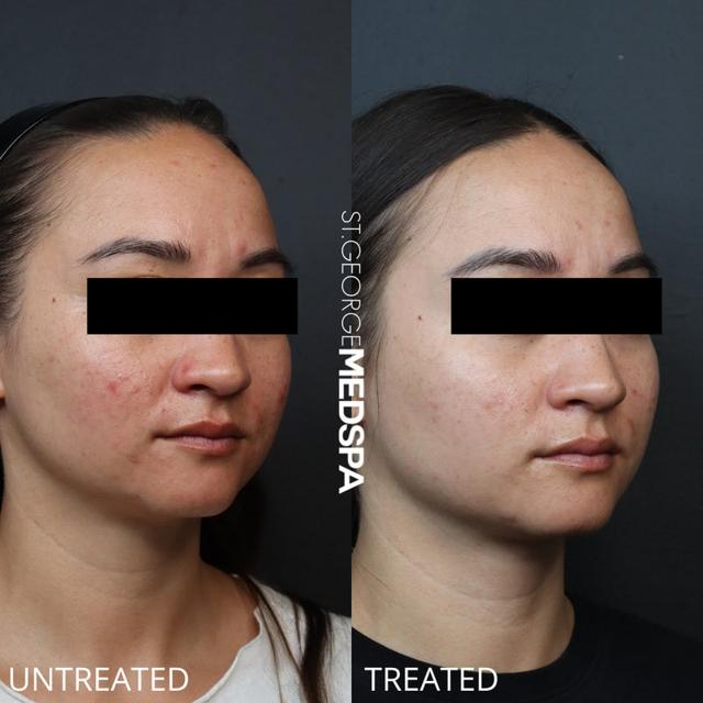 Chemical Peel result at St. George Med Spa in St. George, UT