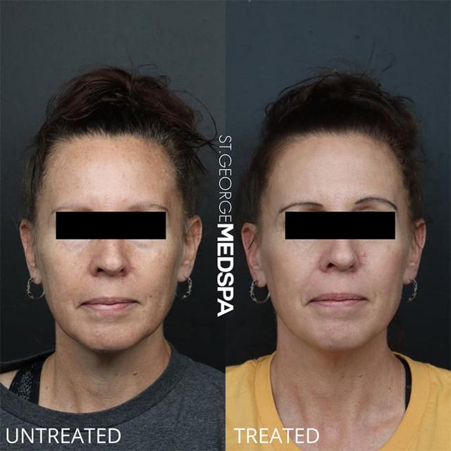 Laser Skin Resurfacing result at St. George Med Spa in St. George, UT