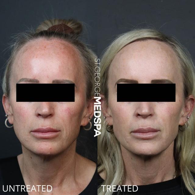 Laser Skin Resurfacing result at St. George Med Spa in St. George, UT