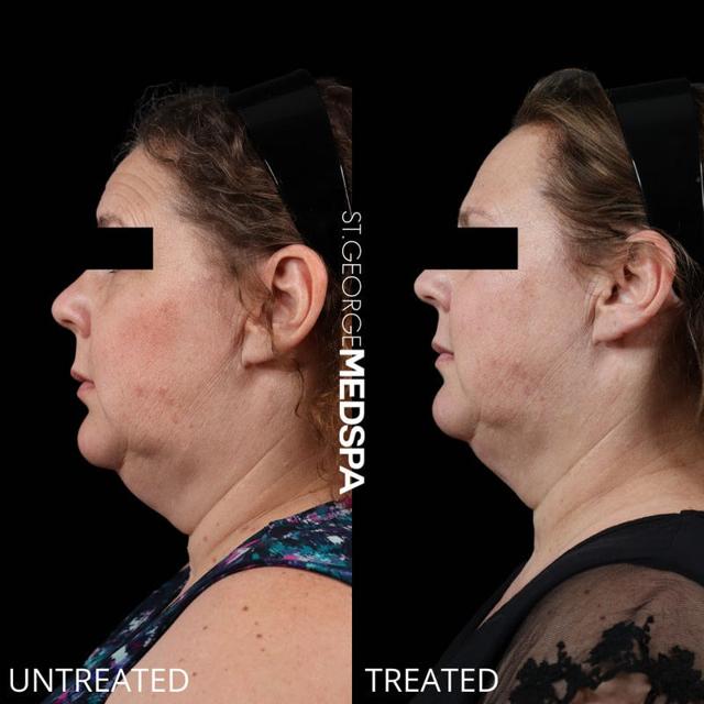 Kybella result at St. George Med Spa in St. George, UT