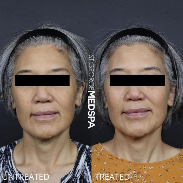 Laser Skin Resurfacing result at St. George Med Spa in St. George, UT