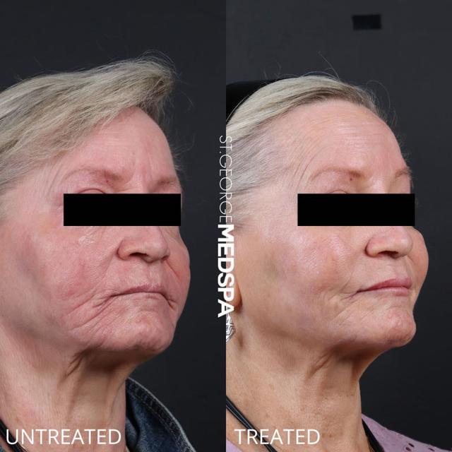 Dermal Fillers result at St. George Med Spa in St. George, UT