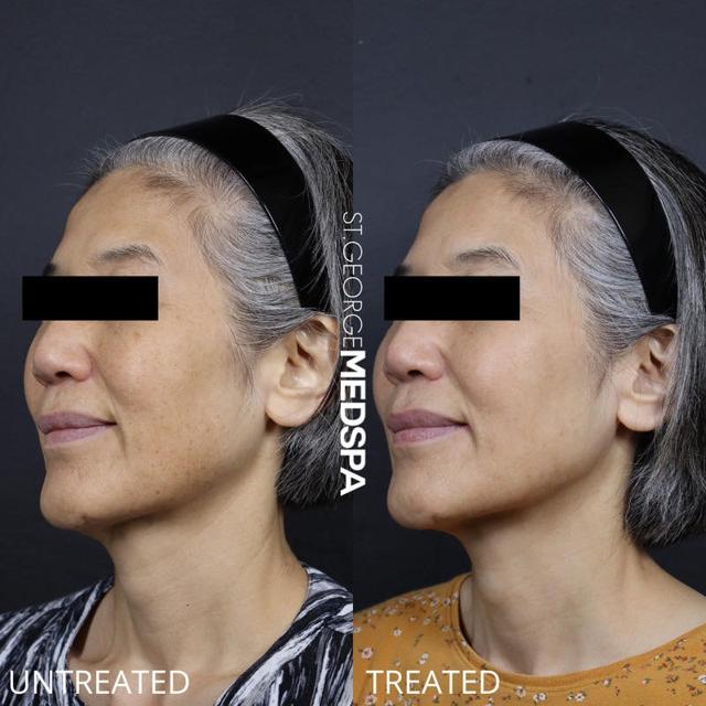 Laser Skin Resurfacing result at St. George Med Spa in St. George, UT