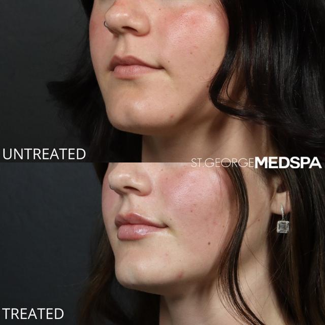 Lip Filler result at St. George Med Spa in St. George, UT