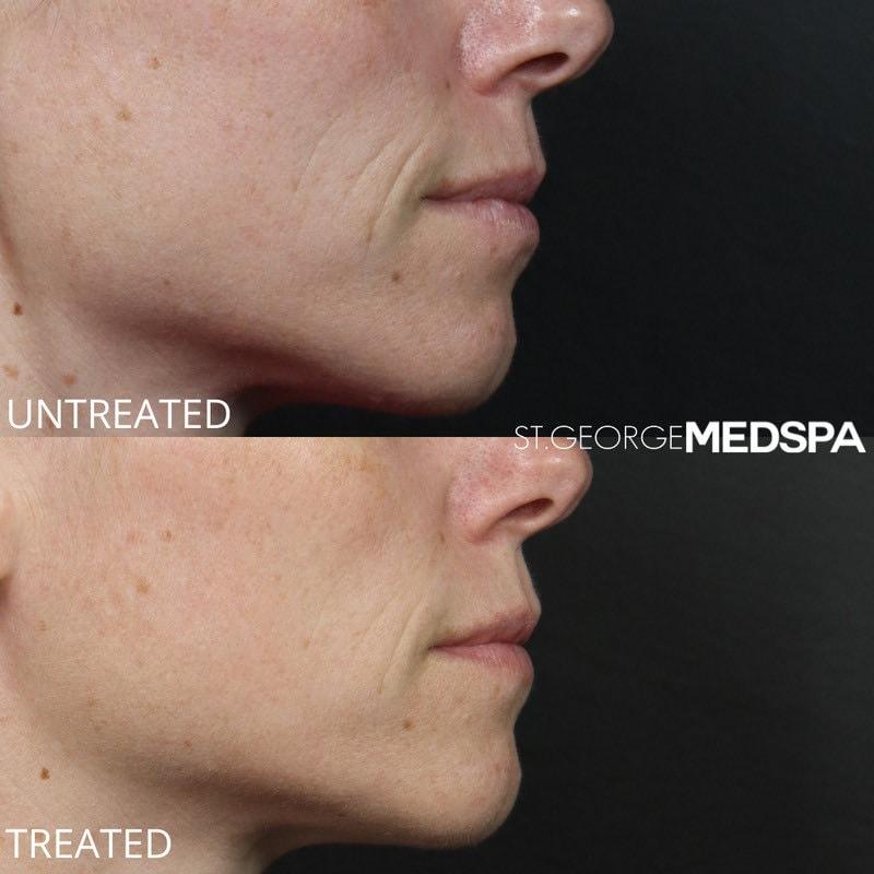 St. George Med Spa microneedling result — St. George, UT