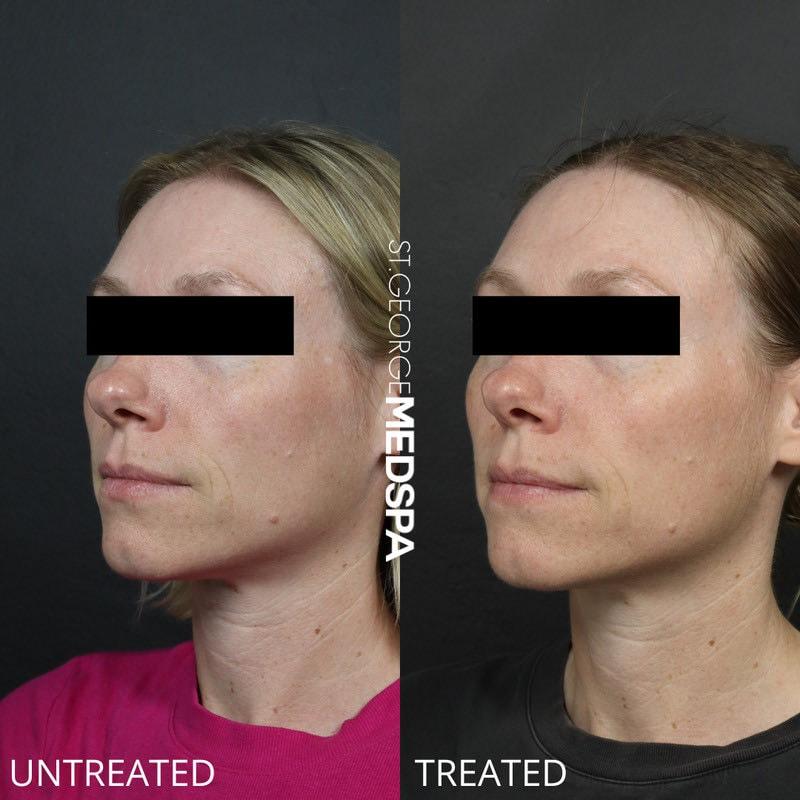 St. George Med Spa microneedling result — St. George, UT