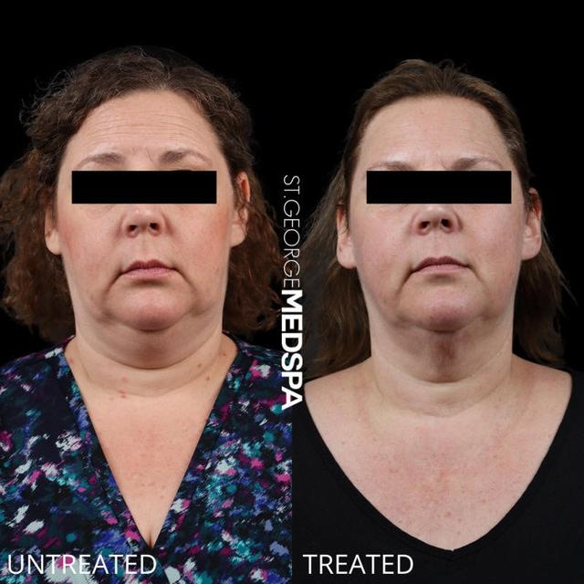 Kybella result at St. George Med Spa in St. George, UT
