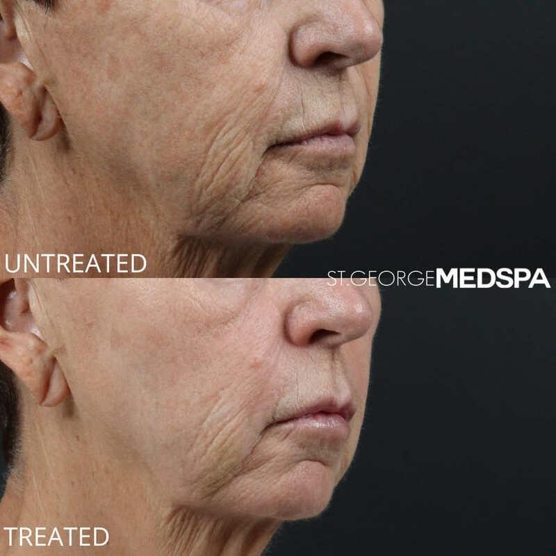 St. George Med Spa skin tightening result — St. George, UT