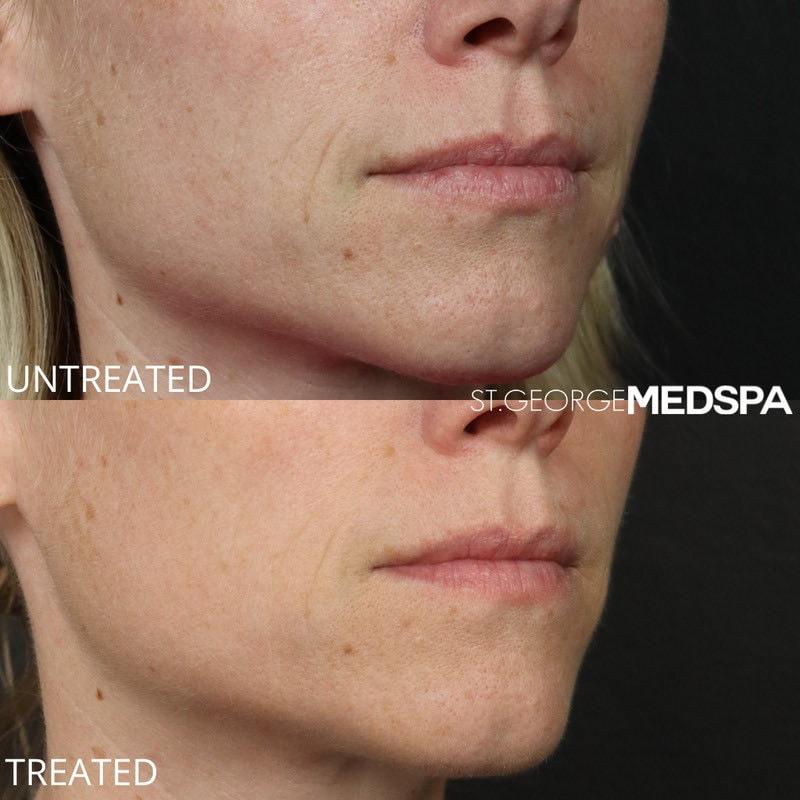 St. George Med Spa microneedling result — St. George, UT