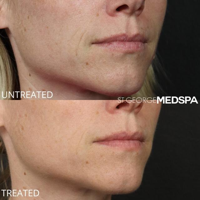 Microneedling result at St. George Med Spa in St. George, UT